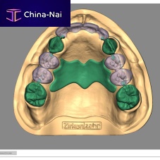 Dental restoration software Partial-Plannerimport3D simulationfor dental prosthesis design