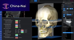 Cephalometric analysis software Romexis® orthodontic3D viewing3D simulation